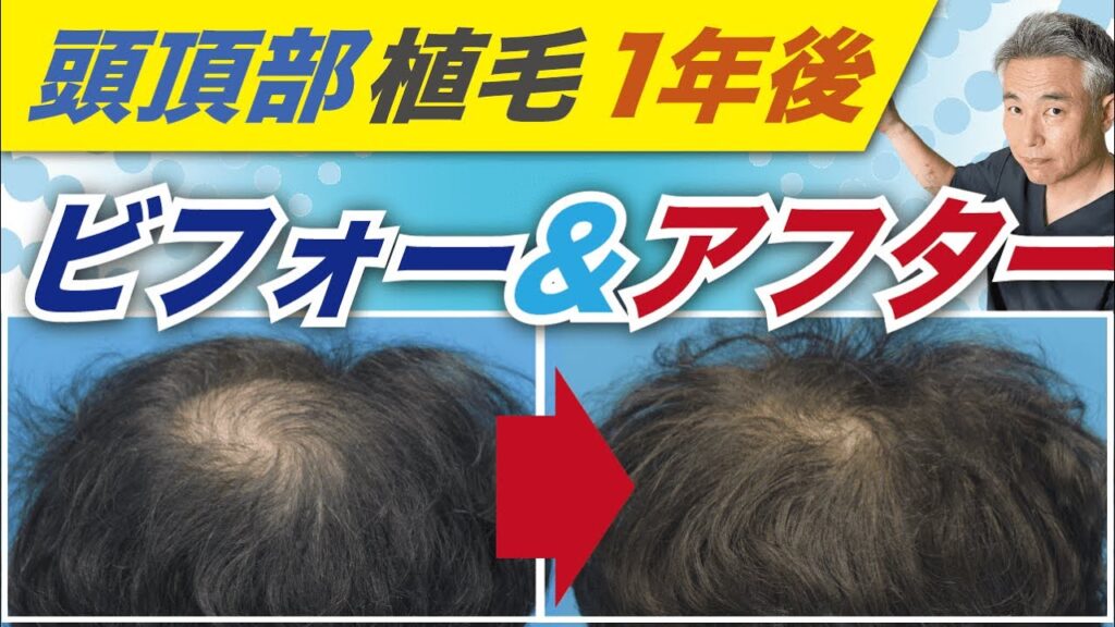 頭頂部植毛から1年経過した患者さんの植毛ビフォー＆アフターのご紹介です