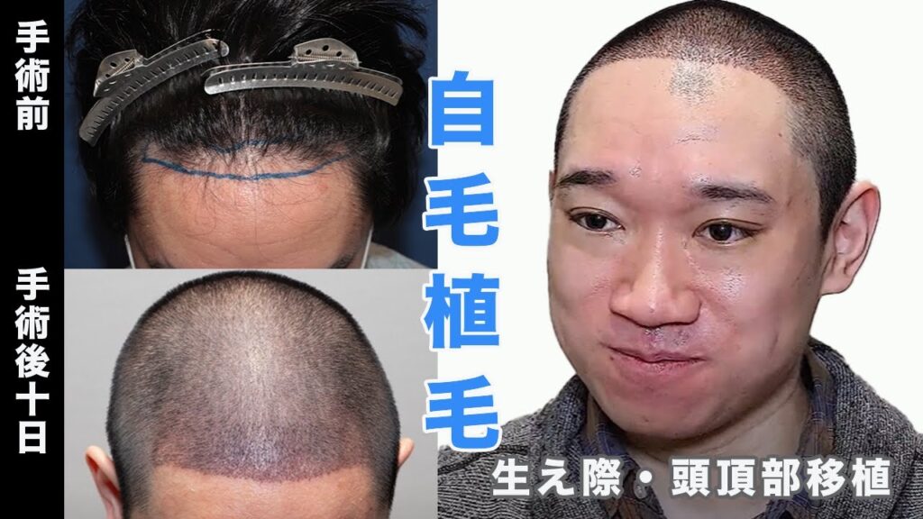 【自毛植毛10日後】生え際・頭頂部に2000株の自毛植毛を受けられた方へインタビューしました【植毛】【薄毛治療】