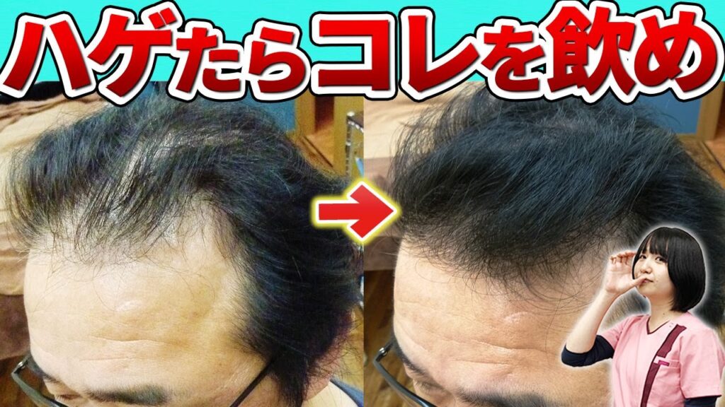 【発毛のプロが推奨】薄毛改善におすすめのサプリメントを紹介