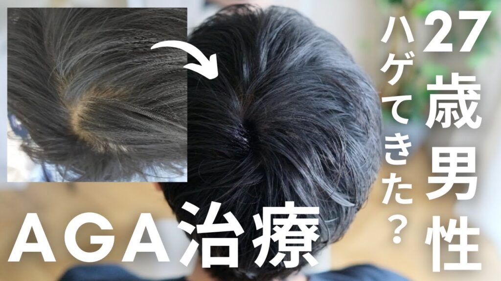 【AGA】ハゲてました。27歳男性の薄毛治療の全てを語ります。