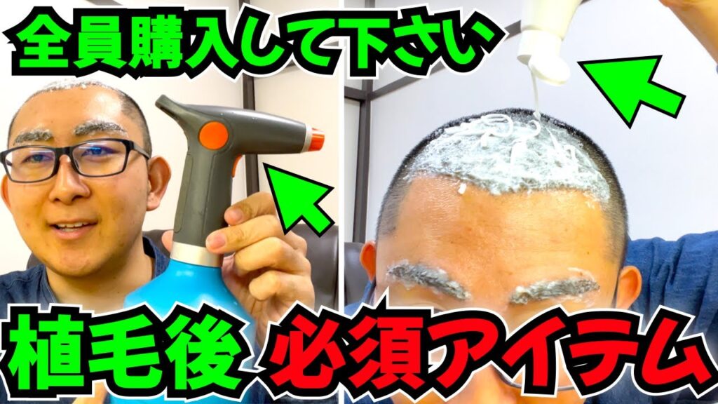 【植毛後 洗い方】絶対にローションを霧吹きで吹き飛ばしてからシャンプーして!!【自毛植毛|薄毛の窓口】