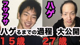 【若ハゲ】髪がフサフサ→ハゲ　までの過程　写真まとめてみた