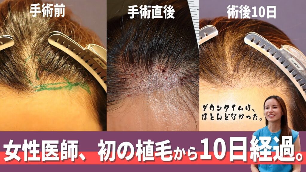 【美容植毛】女医、藤井先生の自毛植毛10日後の経過を追う！！【薄毛】【自毛植毛】