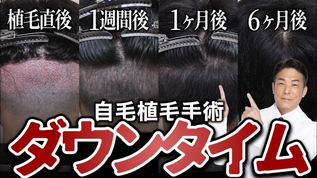 自毛植毛直後の後頭部はどうなっているのか？