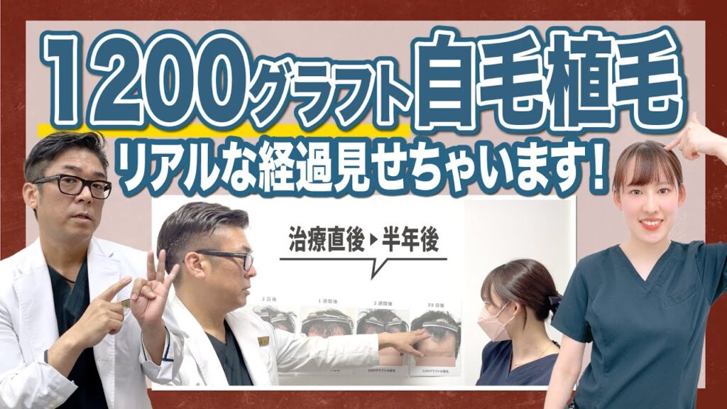 【俺の植毛術】生え際に自毛植毛1200グラフト、術後のリアルな経過を紹介&解説します！