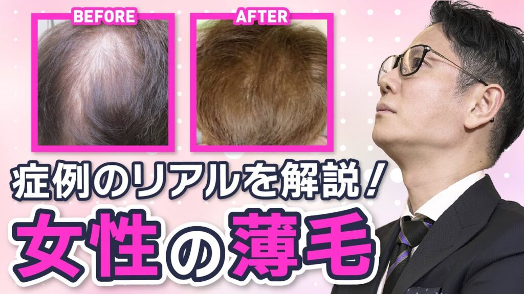 【薄毛治療】女性の薄毛のリアルを、症例写真を見ながら解説!【HARG療法効果】【AGA】