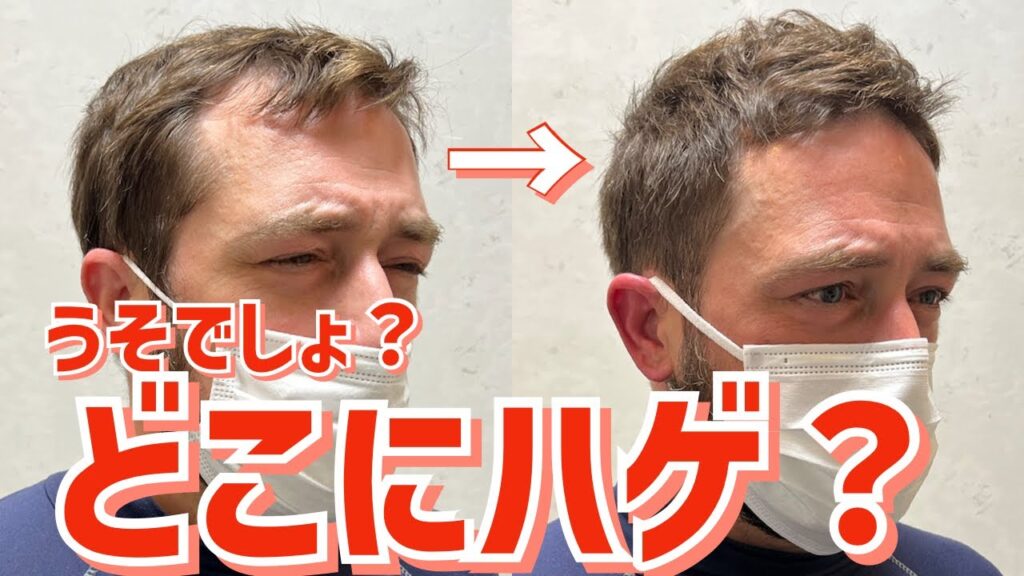 【頭頂部薄毛】M字とつむじはげをカットでカバー