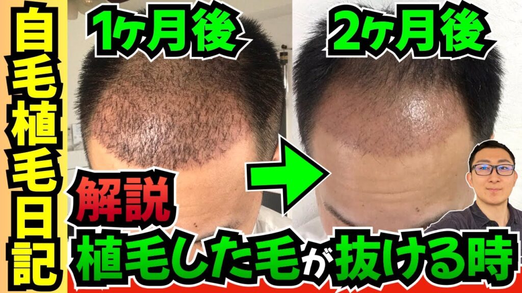 【植毛経過2ヶ月後】自毛植毛した毛は必ず抜け落ちます 心の準備を！【薄毛の窓口｜トルコ植毛】