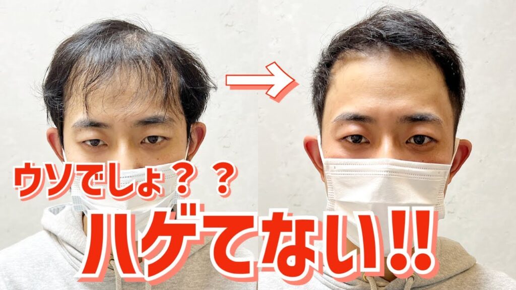 【薄毛】薄毛専門の美容師が教えるM字ハゲスタイリング