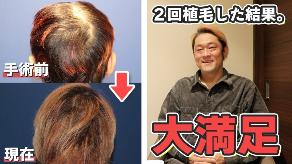 【自毛植毛】MAX鈴木さん2回の自毛手術から1年後の様子について！【植毛】【薄毛治療】