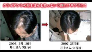 ハゲを克服して髪が生えてきた人たちの喜びの声