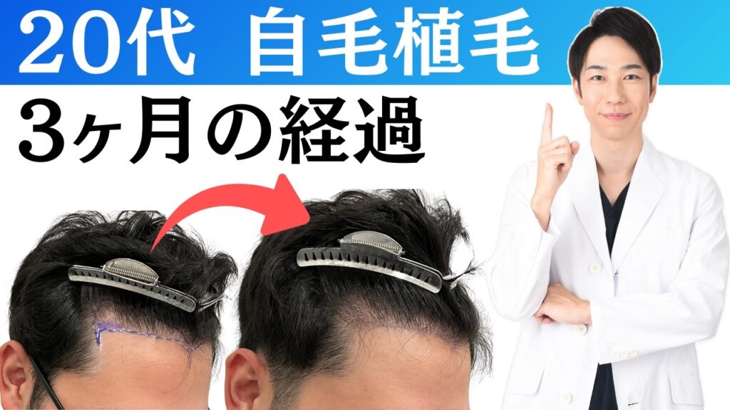 【自毛植毛】20代男性の2回目の植毛 3ヶ月の経過【ショックロス】