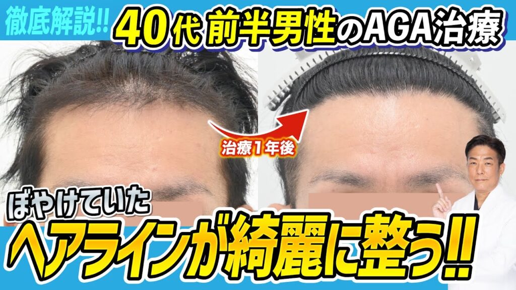 【徹底解説】AGAの影響で後退＋ぼやけた生え際が1年後に綺麗に整う！-40代男性の薄毛治療解説-