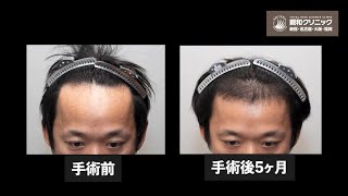 【植毛5ヶ月後 生え始め】二宮祥平ホワイトベースさん 植毛手術後5ヶ月経過を追います【植毛】