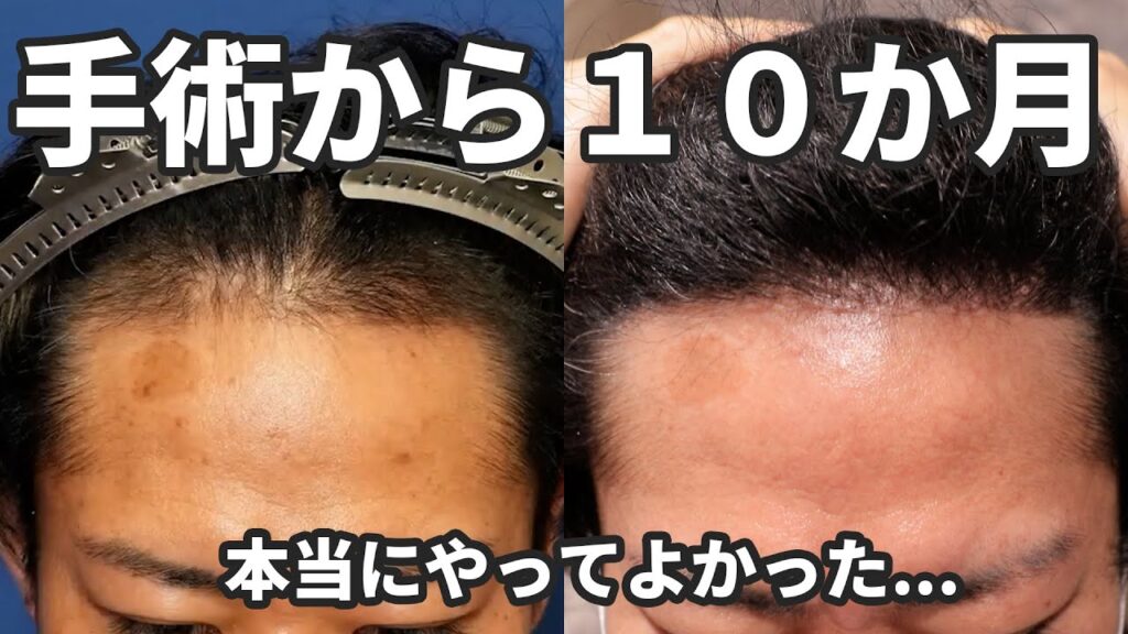 【自毛植毛10ヶ月経過】合計3,300株を植毛したW様に経過をお伺いしました！【薄毛治療】【植毛】