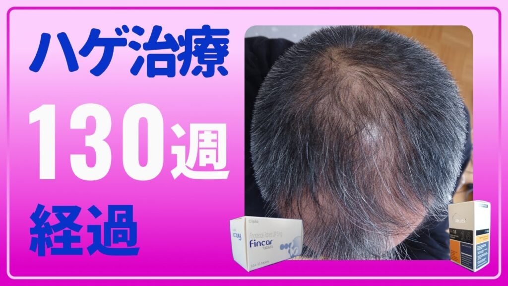 【はげ治療 130週経過 AGA 】フィナステリドとミノキシジルでふさふさを目指す！！おっさんが挑む薄毛治療
