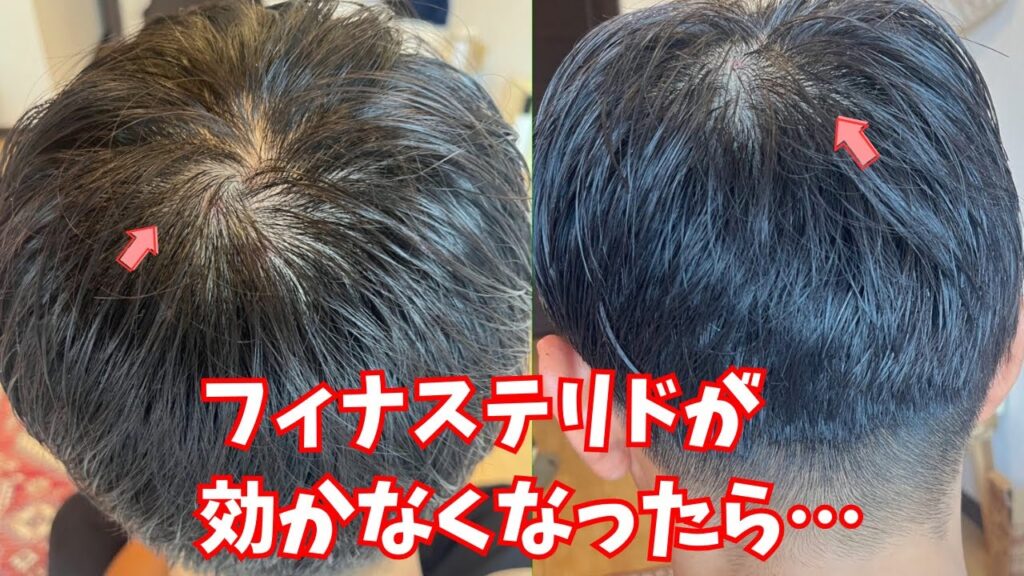 フィナステリドが効かなくなったら…原因とするべき3つの対策とは?