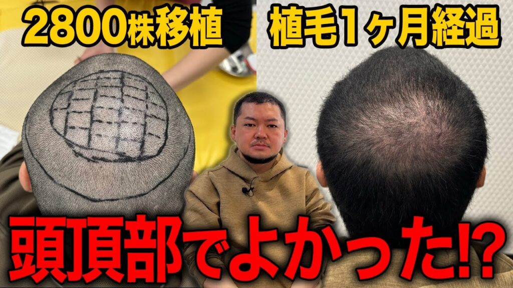 【30代薄毛】頭頂部の植毛から1ヶ月経過して別の問題が発生...!?
