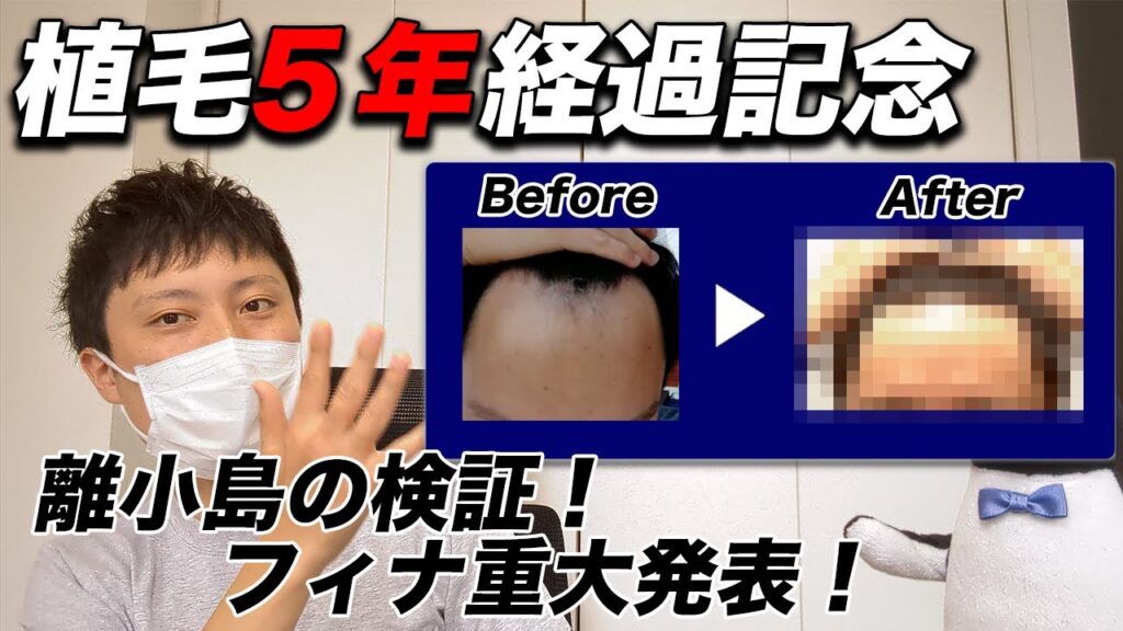 成功？失敗？アスク井上自毛植毛５年経過！