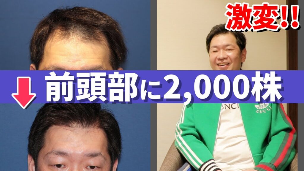 【自毛植毛】実際に自毛植毛を受けられた体験者様にお話を聞きました！【植毛】【薄毛治療】