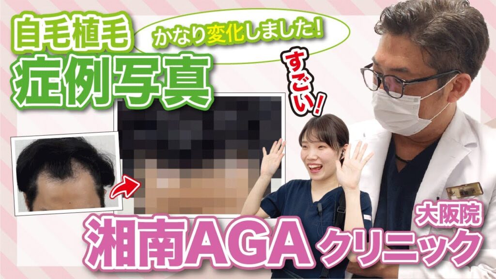 【自毛植毛後の症例紹介】当院で自毛植毛したらどれくらい印象が変わるのか症例写真をご紹介します！