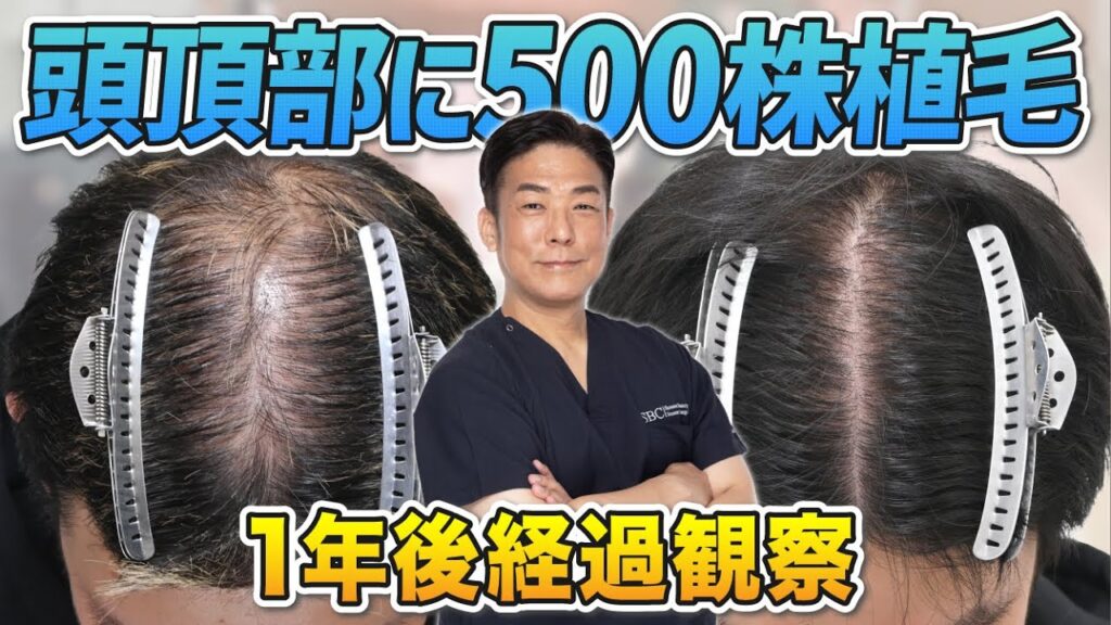 【30代男性】頭頂部に500グラフト植毛して1年後経過観察の様子をお届け！