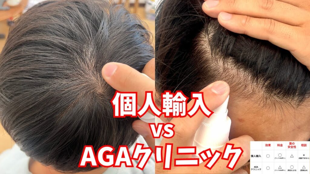 【決定版】薄毛治療に個人輸入とAGAクリニックはどっちがいい？料金から安全性までメリット・デメリットを徹底比較！