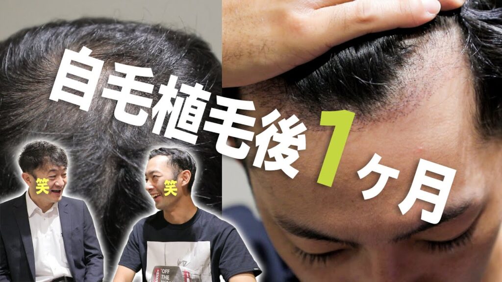 【植毛 手術】モニター患者様へ術後1ヶ月の経過を伺いました【自毛植毛 体験談】