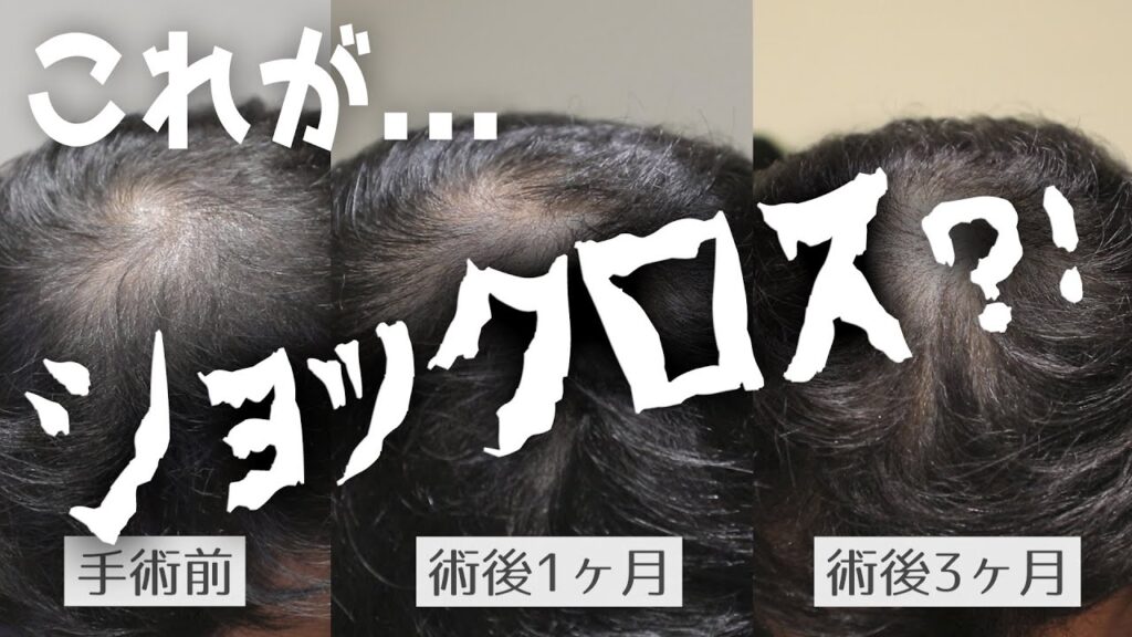 【植毛 手術】モニター患者様の術後3ヶ月経過を伺いました【自毛植毛】