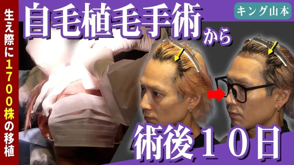 【自毛植毛】キング山本さんの植毛手術当日～10日後までの様子！！【植毛】【薄毛】