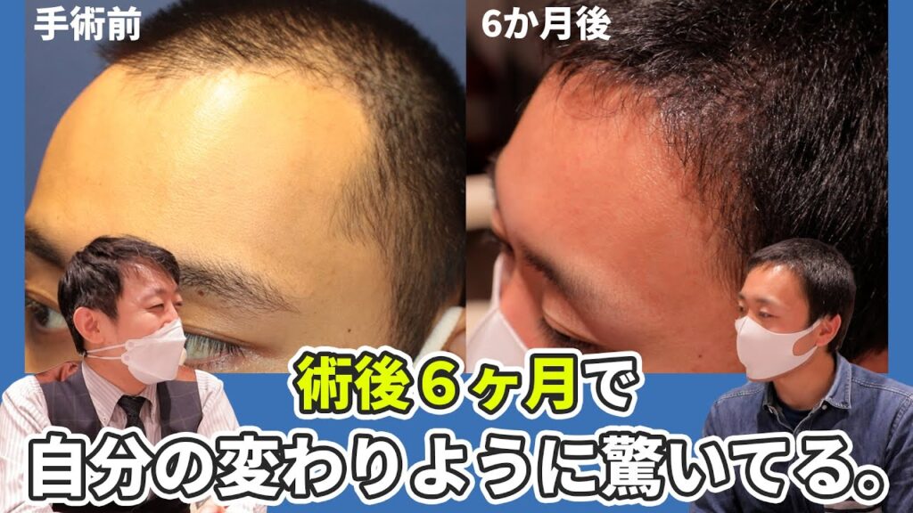 【自毛植毛6ヶ月経過】自毛植毛手術当日から6ヶ月までの経過をお伺いしました！【植毛】【薄毛治療】