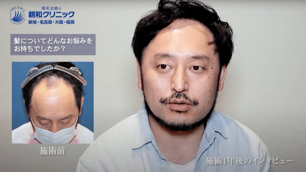 【自毛植毛 術後12ヶ月】生え際、前頭部に2000株移植した43歳の体験者へ率直な感想を伺いました。　親和クリニック【 新宿・名古屋・大阪・福岡 】