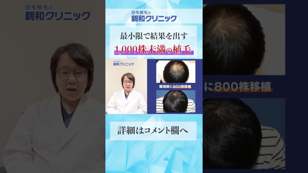 【自毛植毛】1000株未満の自毛植毛の症例をご紹介！【薄毛】【AGA】#shorts
