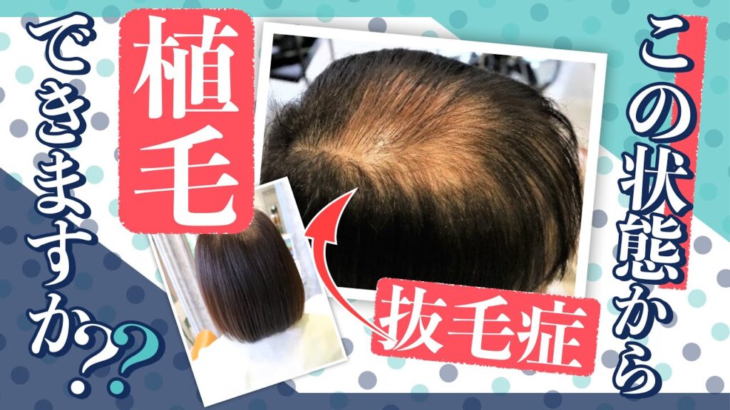 抜毛症で頭頂部の髪が少なくてもこの状態から植毛することは可能？【抜毛症改善協会コラボ】