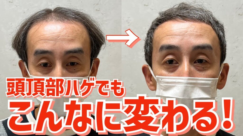 【薄毛】つむじはげが大変身！カットだけで劇的に変わる