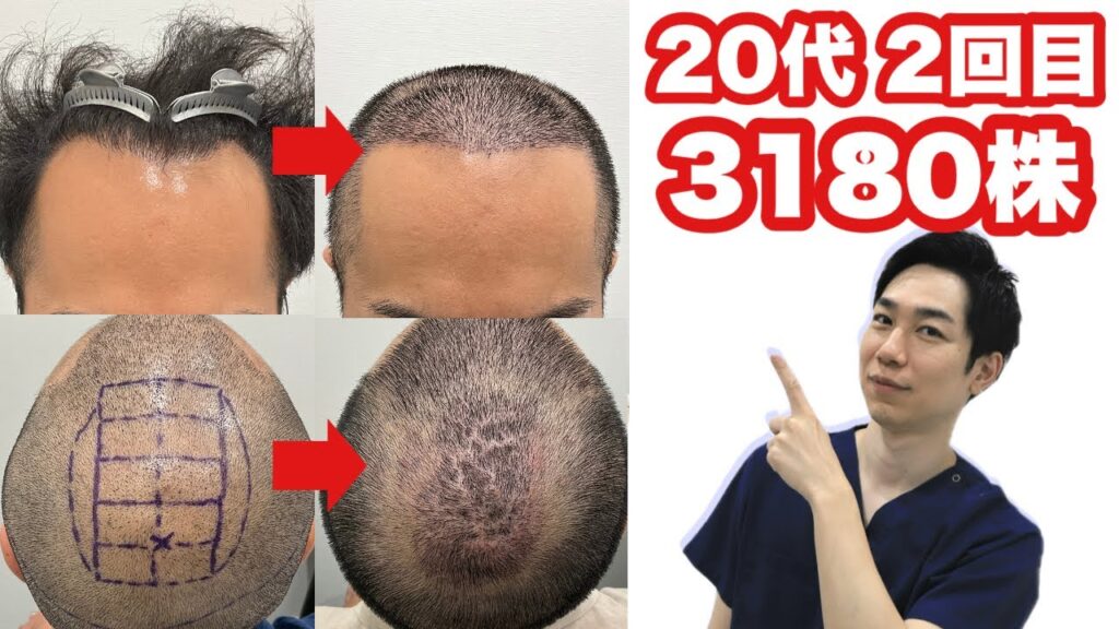 【3000株以上】20代 男性 生え際〜頭頂部への広範囲の薄毛に対する自毛植毛【2回目の植毛】