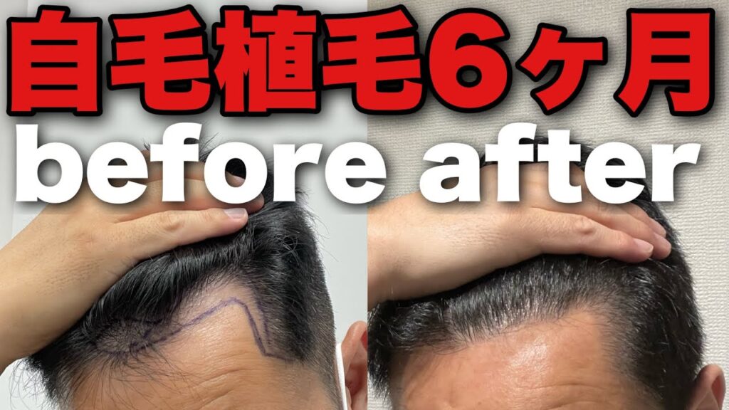 M字ハゲに自毛植毛して6ヶ月の経過