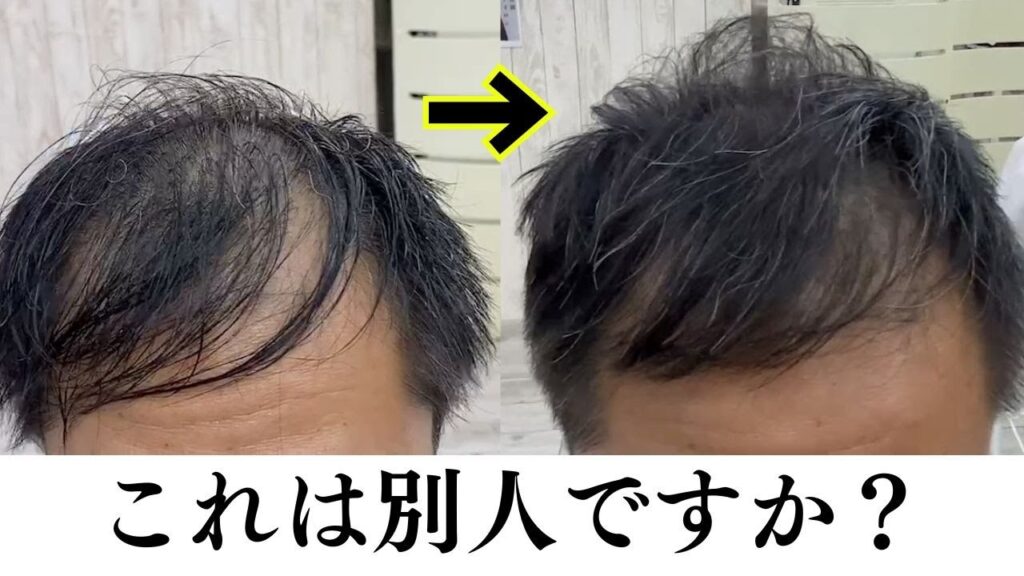 【薄毛カバー】M字ハゲを目立たせない若返りカット!