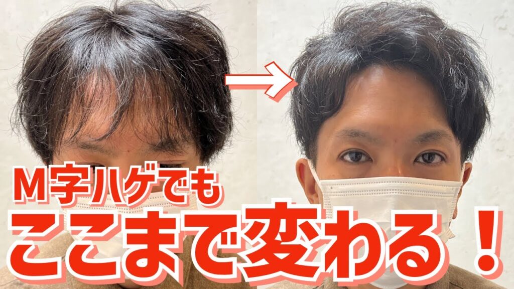 【薄毛】M字前髪気になる割れ目がカットで大変身!!
