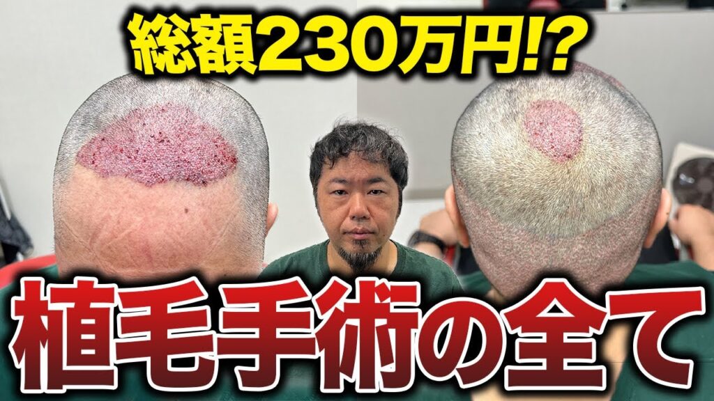 【植毛医にガチ相談】失敗したくないけど費用が不安…27年間薄毛に悩んできたメンズの最終決断とは？
