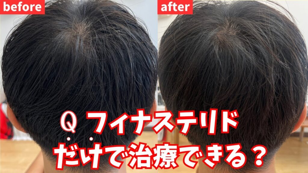 フィナステリドだけで薄毛治療はできる?フィナステリド一生飲む?ミノキシジルなしでAGAな治るのか。