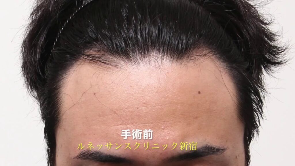 植毛の経過と効果　手術半年後　湘南美容外科AGAルネッサンスクリニック