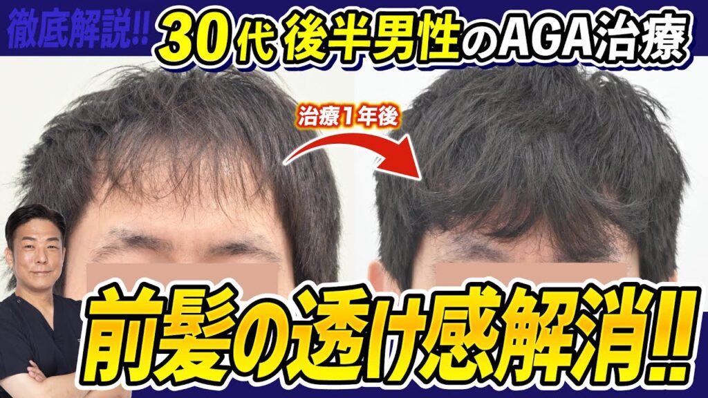 【徹底解説】AGAで後退した生え際が1年後には大改善!!透けていた前髪もふさふさに！-30代男性の治療解説-