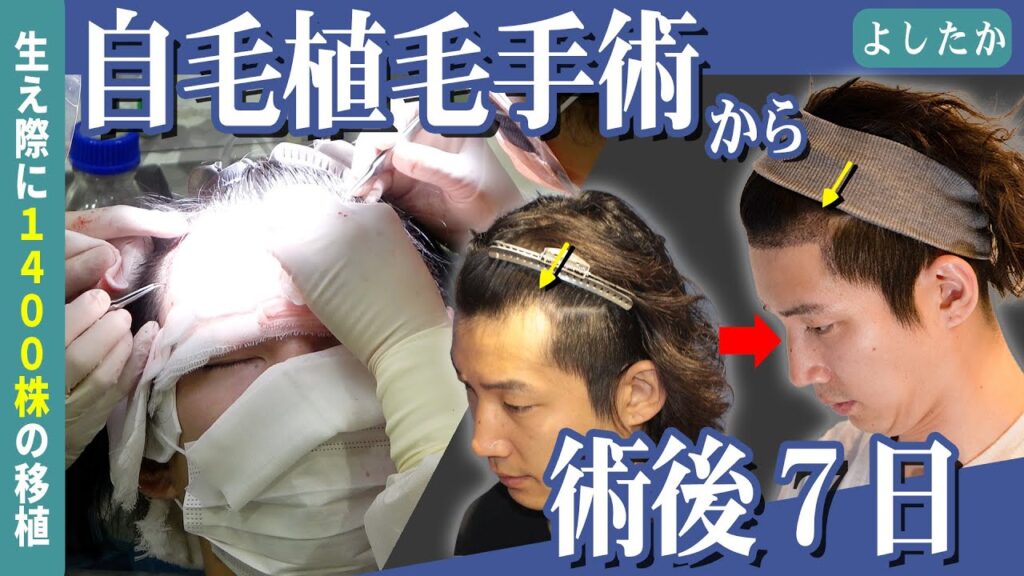 【自毛植毛】よしたか先生の植毛手術当日～10日後までを追う！！【植毛】【薄毛】