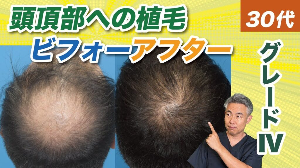 【症例紹介】30代グレードⅣ 頭頂部植毛10ヶ月後のリアル