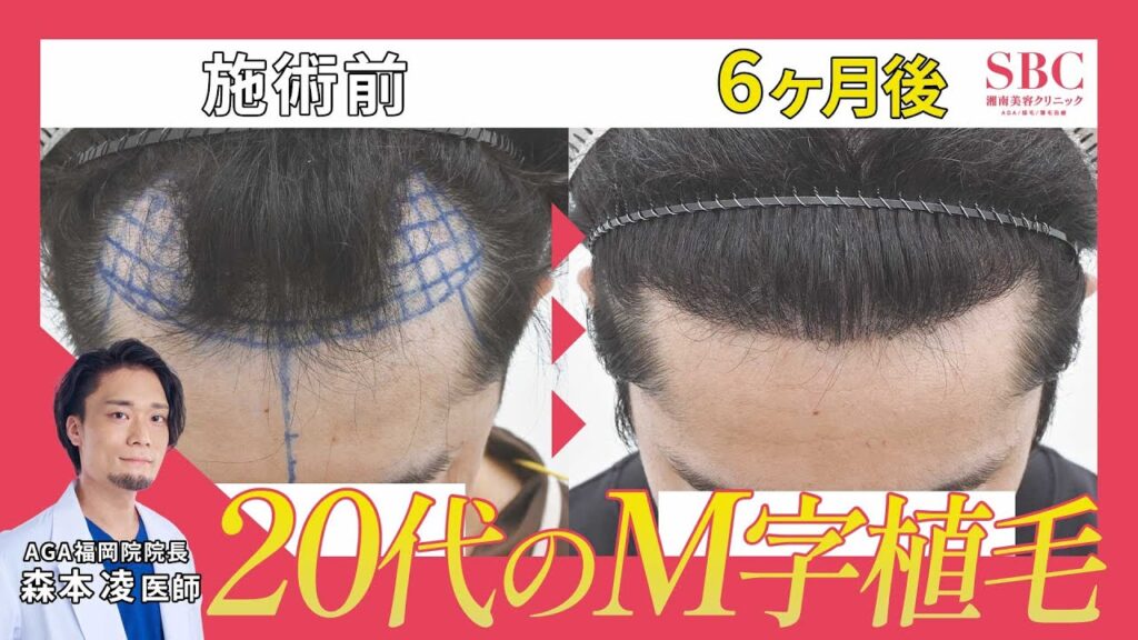【後悔しない自毛植毛】FUE(1400グラフト)経過を医師が解説!半年で高密度の生え際に!