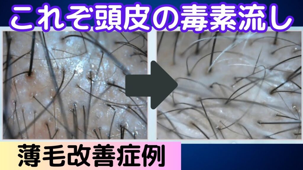 頭皮マッサージ前に2分プラスするだけで育毛効果爆上げ!老廃物を排出して薄毛、抜け毛を改善。白髪予防!実例写真も紹介