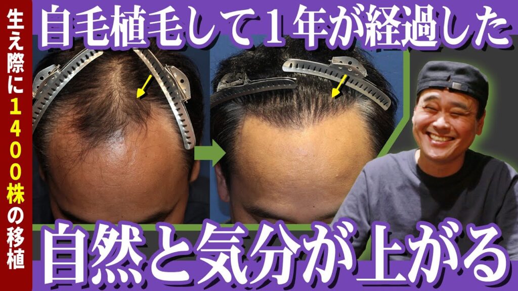 【自毛植毛】YouTuberのガデュ『動く！デカ盛りんぐ』さんの自毛植毛手術から1年経過の様子を追う。【植毛】