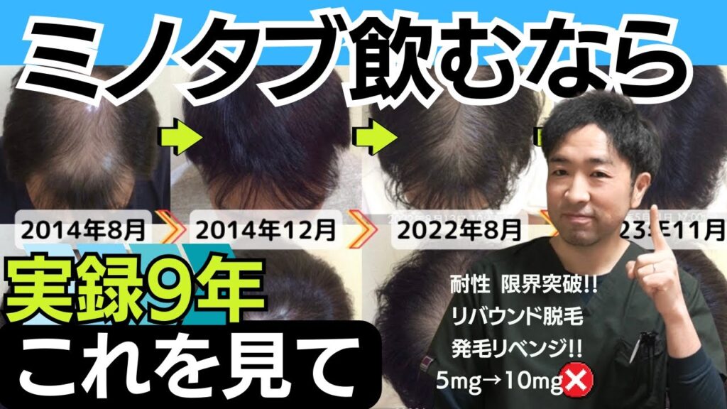 ミノタブの発毛効果を最大限にする方法。薬の耐性を超えて重度のAGA改善！やめるリスクと初期脱毛/個人輸入/10mgは意味無し？全て解説します