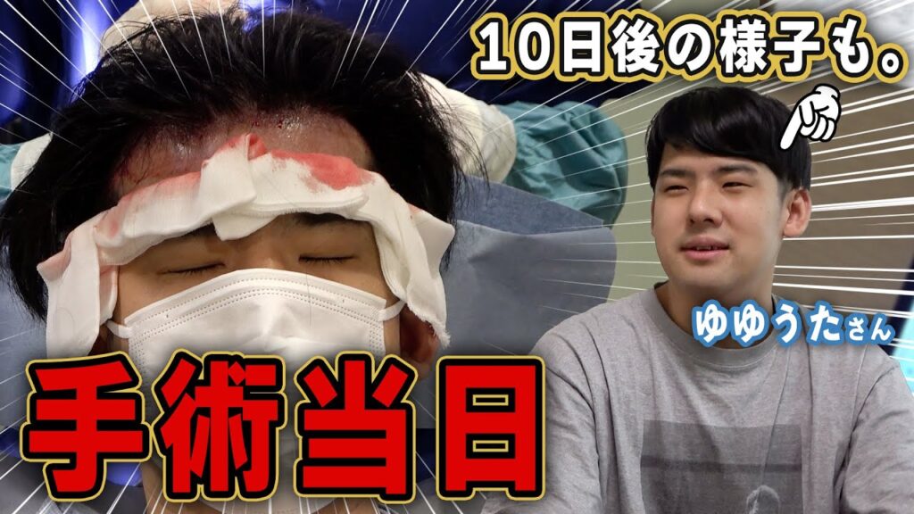 【自毛植毛】有名YouTuberゆゆうたさんの植毛手術当日～10日後までの様子！！【植毛】【薄毛】